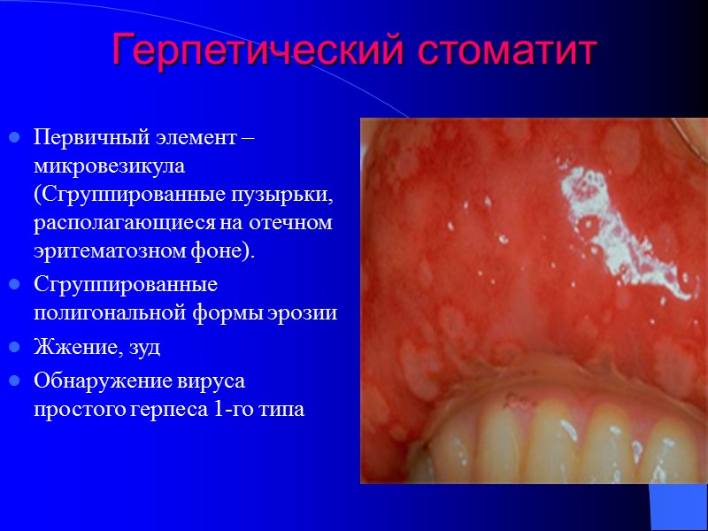 Герпетический стоматит Первичный элемент – микровезикула (Сгруппированные пузырьки, располагающиеся на отечном эритематозном фоне). Сгруппированные